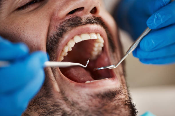 Best Emergency Dentist for Lost Fillings or Crowns in Indian Lake, TX